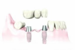 colocacion-implante-dental-300x200.jpg